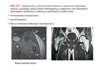 • MRI HIP : Osteonecrosis, Occult femoral fractures, Labral tears Soft-tissue
injuries, including various tendon abnormalities,compressive and entrapment
neuropathies (piriformis syndrome), and Morel-Lavallée lesion
• Posttraumatic osteonecrosis
• Occult fractures
• Bone contusions (trabecular microfractures
Morel-Lavallée lesion
 