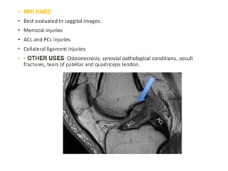 • MRI KNEE
• Best evaluated in saggital images.
• Meniscal injuries
• ACL and PCL injuries
• Collateral ligament injuries
• • OTHER USES: Osteonecrosis, synovial pathological conditions, occult
fractures, tears of patellar and quadriceps tendon.
 