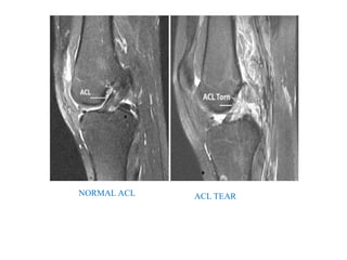 NORMAL ACL ACL TEAR
 