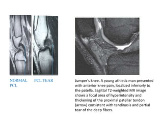 Jumper's knee. A young athletic man presented
with anterior knee pain, localized inferiorly to
the patella. Sagittal T2-weighted MR image
shows a focal area of hyperintensity and
thickening of the proximal patellar tendon
(arrow) consistent with tendinosis and partial
tear of the deep fibers.
NORMAL
PCL
PCL TEAR
 