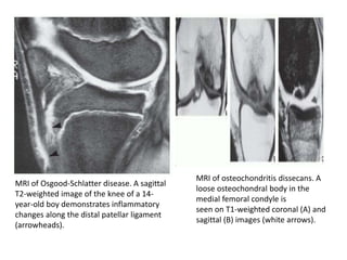 MRI of Osgood-Schlatter disease. A sagittal
T2-weighted image of the knee of a 14-
year-old boy demonstrates inflammatory
changes along the distal patellar ligament
(arrowheads).
MRI of osteochondritis dissecans. A
loose osteochondral body in the
medial femoral condyle is
seen on T1-weighted coronal (A) and
sagittal (B) images (white arrows).
 