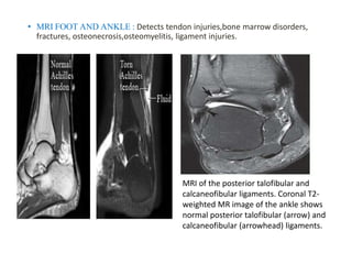 • MRI FOOT AND ANKLE : Detects tendon injuries,bone marrow disorders,
fractures, osteonecrosis,osteomyelitis, ligament injuries.
MRI of the posterior talofibular and
calcaneofibular ligaments. Coronal T2-
weighted MR image of the ankle shows
normal posterior talofibular (arrow) and
calcaneofibular (arrowhead) ligaments.
 