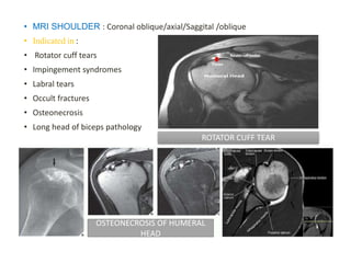 • MRI SHOULDER : Coronal oblique/axial/Saggital /oblique
• Indicated in :
• Rotator cuff tears
• Impingement syndromes
• Labral tears
• Occult fractures
• Osteonecrosis
• Long head of biceps pathology
ROTATOR CUFF TEAR
OSTEONECROSIS OF HUMERAL
HEAD
 