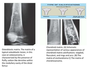 Osteoblastic matrix. The matrix of a
typical osteoblastic lesion, in this
case an osteosarcoma, is
characterized by the presence of
fluffy, cotton-like densities within
the medullary cavity of the distal
femur.
Chondroid matrix. (A) Schematic
representation of various appearances of
chondroid matrix calcifications: stippled,
flocculent, and rings and arcs. (B) The
matrix of enchondroma C) The matrix of
chondrosarcoma.
 