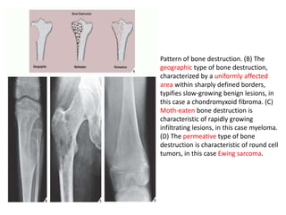Pattern of bone destruction. (B) The
geographic type of bone destruction,
characterized by a uniformly affected
area within sharply defined borders,
typifies slow-growing benign lesions, in
this case a chondromyxoid fibroma. (C)
Moth-eaten bone destruction is
characteristic of rapidly growing
infiltrating lesions, in this case myeloma.
(D) The permeative type of bone
destruction is characteristic of round cell
tumors, in this case Ewing sarcoma.
 