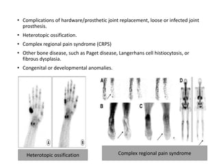 • Complications of hardware/prosthetic joint replacement, loose or infected joint
prosthesis.
• Heterotopic ossification.
• Complex regional pain syndrome (CRPS)
• Other bone disease, such as Paget disease, Langerhans cell histiocytosis, or
fibrous dysplasia.
• Congenital or developmental anomalies.
Heterotopic ossification Complex regional pain syndrome
 