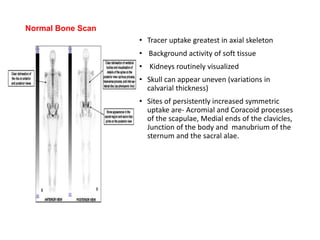Normal Bone Scan
• Tracer uptake greatest in axial skeleton
• Background activity of soft tissue
• Kidneys routinely visualized
• Skull can appear uneven (variations in
calvarial thickness)
• Sites of persistently increased symmetric
uptake are- Acromial and Coracoid processes
of the scapulae, Medial ends of the clavicles,
Junction of the body and manubrium of the
sternum and the sacral alae.
 