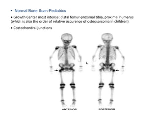 • Normal Bone Scan-Pediatrics
 Growth Center most intense: distal femur-proximal tibia, proximal humerus
(which is also the order of relative occurence of osteosarcoma in children)
 Costochondral junctions
 