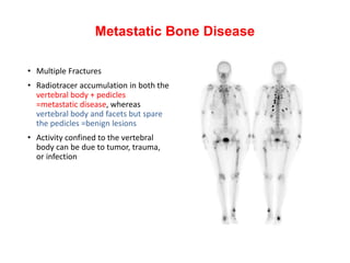 Metastatic Bone Disease
• Multiple Fractures
• Radiotracer accumulation in both the
vertebral body + pedicles
=metastatic disease, whereas
vertebral body and facets but spare
the pedicles =benign lesions
• Activity confined to the vertebral
body can be due to tumor, trauma,
or infection
 