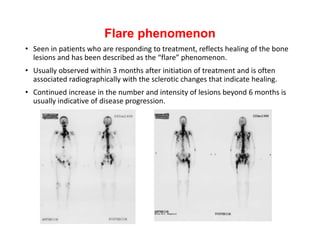 Flare phenomenon
• Seen in patients who are responding to treatment, reflects healing of the bone
lesions and has been described as the “flare” phenomenon.
• Usually observed within 3 months after initiation of treatment and is often
associated radiographically with the sclerotic changes that indicate healing.
• Continued increase in the number and intensity of lesions beyond 6 months is
usually indicative of disease progression.
 