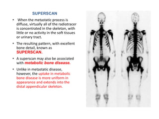 SUPERSCAN
• When the metastatic process is
diffuse, virtually all of the radiotracer
is concentrated in the skeleton, with
little or no activity in the soft tissues
or urinary tract.
• The resulting pattern, with excellent
bone detail, known as
SUPERSCAN.
• A superscan may also be associated
with metabolic bone disease.
• Unlike in metastatic disease,
however, the uptake in metabolic
bone disease is more uniform in
appearance and extends into the
distal appendicular skeleton.
 