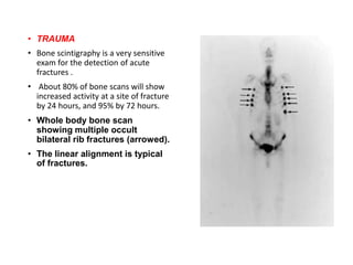 • TRAUMA
• Bone scintigraphy is a very sensitive
exam for the detection of acute
fractures .
• About 80% of bone scans will show
increased activity at a site of fracture
by 24 hours, and 95% by 72 hours.
• Whole body bone scan
showing multiple occult
bilateral rib fractures (arrowed).
• The linear alignment is typical
of fractures.
 