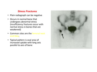 Stress Fractures
• Plain radiograph can be negative
• Occurs in normal bone that
undergoes abnormal stress
(insufficiency fractures occur with
normal stress in bones that are
weakened)
• Common sites are the femoral neck
and tibia.
• Typical pattern is oval area of
increased uptake with long axis
parallel to axis of bone
 