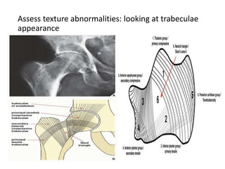 Assess texture abnormalities: looking at trabeculae
appearance
 