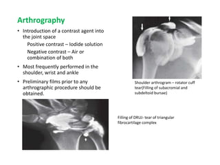 Arthrography
• Introduction of a contrast agent into
the joint space
Positive contrast – Iodide solution
Negative contrast – Air or
combination of both
• Most frequently performed in the
shoulder, wrist and ankle
• Preliminary films prior to any
arthrographic procedure should be
obtained.
Shoulder arthrogram – rotator cuff
tear(Filling of subacromial and
subdeltoid bursae)
Filling of DRUJ- tear of triangular
fibrocartilage complex
 