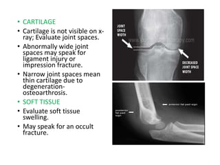 • CARTILAGE
• Cartilage is not visible on x-
ray; Evaluate joint spaces.
• Abnormally wide joint
spaces may speak for
ligament injury or
impression fracture.
• Narrow joint spaces mean
thin cartilage due to
degeneration-
osteoarthrosis.
• SOFT TISSUE
• Evaluate soft tissue
swelling.
• May speak for an occult
fracture.
 