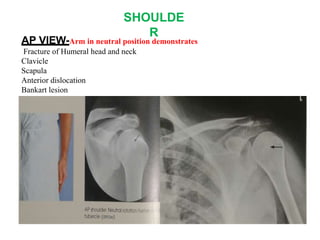 SHOULDE
R
AP VIEW-Arm in neutral position demonstrates
Fracture of Humeral head and neck
Clavicle
Scapula
Anterior dislocation
Bankart lesion
 