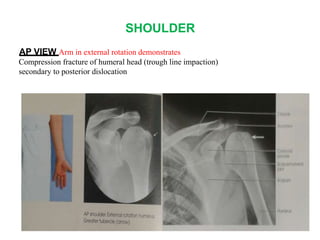 SHOULDER
AP VIEW Arm in external rotation demonstrates
Compression fracture of humeral head (trough line impaction)
secondary to posterior dislocation
 