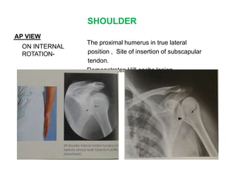 SHOULDER
AP VIEW
ON INTERNAL
ROTATION-
The proximal humerus in true lateral
position , Site of insertion of subscapular
tendon.
Demonstrates Hill-sachs lesion
 