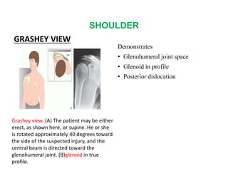 SHOULDER
GRASHEY VIEW
Demonstrates
• Glenohumeral joint space
• Glenoid in profile
• Posterior dislocation
Grashey view. (A) The patient may be either
erect, as shown here, or supine. He or she
is rotated approximately 40 degrees toward
the side of the suspected injury, and the
central beam is directed toward the
glenohumeral joint. (B)glenoid in true
profile.
 