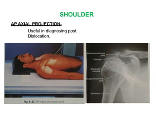 SHOULDER
AP AXIAL PROJECTION-
Useful in diagnosing post.
Dislocation.
 