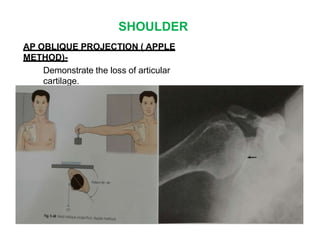 SHOULDER
AP OBLIQUE PROJECTION ( APPLE
METHOD)-
Demonstrate the loss of articular
cartilage.
 