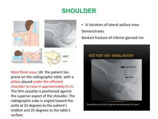 SHOULDER
• A Variation of lateral axillary view
Demonstrates
Bankart fracture of inferior glenoid rim
West Point view. (A) the patient lies
prone on the radiographic table, with a
pillow placed under the affected
shoulder to raise it approximately 8 cm.
The film cassette is positioned against
the superior aspect of the shoulder. The
radiographic tube is angled toward the
axilla at 25 degrees to the patient's
midline and 25 degrees to the table's
surface.
 