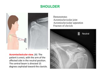 SHOULDER
Acromioclavicular view. (A) The
patient is erect, with the arm of the
affected side in the neutral position.
The central beam is directed 15
degrees cephalad toward the clavicle.
Demonstrates
Acromioclavicular joint
Acromioclavicular separation
Fracture of clavicle
 
