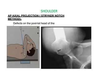 SHOULDER
AP AXIAL PROJECTION ( STRYKER NOTCH
METHOD)-
Defects on the post-lat head of the
humerus.
 