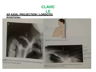 CLAVIC
LE
AP AXIAL PROJECTION ( LORDOTIC
POSITION)-
 