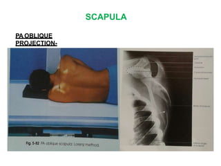 SCAPULA
PA OBLIQUE
PROJECTION-
 