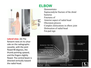 ELBOW
Lateral view. (A) The
forearm rests on its ulnar
side on the radiographic
cassette, with the joint
flexed 90 degrees, the
thumb pointing upward,
and the fingers slightly
flexed. The central beam is
directed vertically toward
the radial head.
Demonstrates
Supracondylar fracture of the distal
humerus
Fractures of
Anterior aspect of radial head
Olecranon process
Complex dislocations in elbow joint
Dislocation of radial head
Fat-pad sign
 