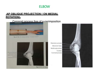 ELBOW
AP OBLIQUE PROJECTION ( ON MEDIAL
ROTATION)-
Coronoid process free of superimposition
 