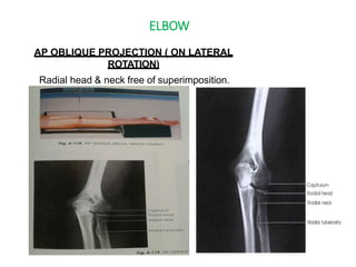 ELBOW
AP OBLIQUE PROJECTION ( ON LATERAL
ROTATION)
Radial head & neck free of superimposition.
 