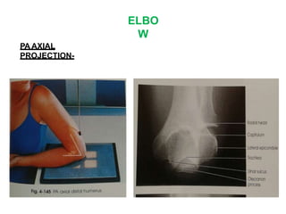 ELBO
W
PA AXIAL
PROJECTION-
 