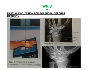 WRIS
T
PAAXIAL PROJECTION FOR SCAPHOID ( STECHER
METHOD)-
 