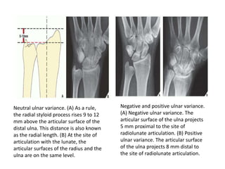 Neutral ulnar variance. (A) As a rule,
the radial styloid process rises 9 to 12
mm above the articular surface of the
distal ulna. This distance is also known
as the radial length. (B) At the site of
articulation with the lunate, the
articular surfaces of the radius and the
ulna are on the same level.
Negative and positive ulnar variance.
(A) Negative ulnar variance. The
articular surface of the ulna projects
5 mm proximal to the site of
radiolunate articulation. (B) Positive
ulnar variance. The articular surface
of the ulna projects 8 mm distal to
the site of radiolunate articulation.
 