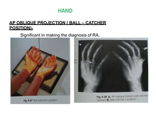 HAND
AP OBLIQUE PROJECTION ( BALL – CATCHER
POSITION)-
Significant in making the diagnosis of RA.
 