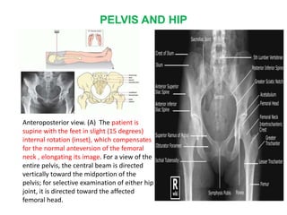 PELVIS AND HIP
Anteroposterior view. (A) The patient is
supine with the feet in slight (15 degrees)
internal rotation (inset), which compensates
for the normal anteversion of the femoral
neck , elongating its image. For a view of the
entire pelvis, the central beam is directed
vertically toward the midportion of the
pelvis; for selective examination of either hip
joint, it is directed toward the affected
femoral head.
 