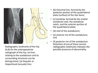 • (b) ilioischial line, formed by the
posterior portion of the quadrilateral
plate (surface) of the iliac bone;
• (c) teardrop, formed by the medial
acetabular wall, the acetabular
notch, and the anterior portion of
the quadrilateral plate;
• (d) roof of the acetabulum;
• (e) anterior rim of the acetabulum;
and
• (f) posterior rim of the acetabulum.
Distortion of any of these normal
radiographic landmarks indicates the
possible presence of abnormality.
Radiographic landmarks of the hip.
(A,B) On the anteroposterior
radiograph of the hip, six lines
relating to the acetabulum and its
surrounding structures can be
distinguished: (a) iliopubic or
iliopectineal (arcuate) line;
 