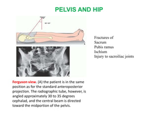 PELVIS AND HIP
Ferguson view. (A) the patient is in the same
position as for the standard anteroposterior
projection. The radiographic tube, however, is
angled approximately 30 to 35 degrees
cephalad, and the central beam is directed
toward the midportion of the pelvis.
Fractures of
Sacrum
Pubis ramus
Ischium
Injury to sacroiliac joints
 