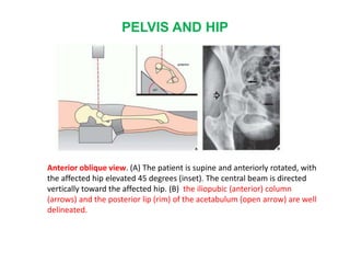 PELVIS AND HIP
Anterior oblique view. (A) The patient is supine and anteriorly rotated, with
the affected hip elevated 45 degrees (inset). The central beam is directed
vertically toward the affected hip. (B) the iliopubic (anterior) column
(arrows) and the posterior lip (rim) of the acetabulum (open arrow) are well
delineated.
 
