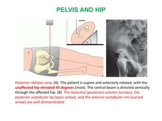 PELVIS AND HIP
Posterior oblique view. (A) The patient is supine and anteriorly rotated, with the
unaffected hip elevated 45 degrees (inset). The central beam is directed vertically
through the affected hip. (B) The ilioischial (posterior) column (arrows), the
posterior acetabular lip (open arrow), and the anterior acetabular rim (curved
arrow) are well demonstrated .
 