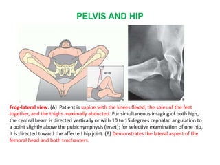 PELVIS AND HIP
Frog-lateral view. (A) Patient is supine with the knees flexed, the soles of the feet
together, and the thighs maximally abducted. For simultaneous imaging of both hips,
the central beam is directed vertically or with 10 to 15 degrees cephalad angulation to
a point slightly above the pubic symphysis (inset); for selective examination of one hip,
it is directed toward the affected hip joint. (B) Demonstrates the lateral aspect of the
femoral head and both trochanters.
 