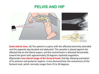 PELVIS AND HIP
Groin-lateral view. (A) The patient is supine with the affected extremity extended
and the opposite leg elevated and abducted. The cassette is placed against the
affected hip on the lateral aspect, and the central beam is directed horizontally
toward the groin with approximately 20 degrees cephalad angulation.
(B)provides true lateral image of the femoral head, thereby allowing evaluation
of its anterior and posterior aspects. It also demonstrates the anteversion of the
femoral neck, which normally ranges from 25 to 30 degrees.
 