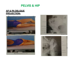 PELVIS & HIP
AP & PA OBLIQUE
PROJECTION-
Resulting image shows entire
ilium
 