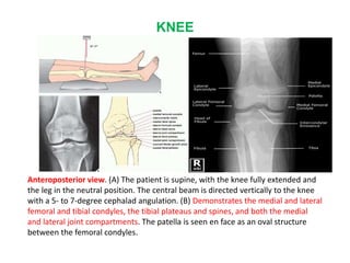 KNEE
Anteroposterior view. (A) The patient is supine, with the knee fully extended and
the leg in the neutral position. The central beam is directed vertically to the knee
with a 5- to 7-degree cephalad angulation. (B) Demonstrates the medial and lateral
femoral and tibial condyles, the tibial plateaus and spines, and both the medial
and lateral joint compartments. The patella is seen en face as an oval structure
between the femoral condyles.
 