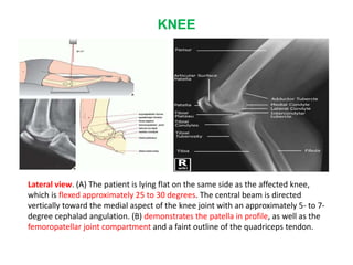 KNEE
Lateral view. (A) The patient is lying flat on the same side as the affected knee,
which is flexed approximately 25 to 30 degrees. The central beam is directed
vertically toward the medial aspect of the knee joint with an approximately 5- to 7-
degree cephalad angulation. (B) demonstrates the patella in profile, as well as the
femoropatellar joint compartment and a faint outline of the quadriceps tendon.
 