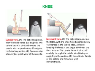 KNEE
Sunrise view. (A) The patient is prone,
with the knee flexed 115 degrees. The
central beam is directed toward the
patella with approximately 15-degree
cephalad angulation. (B) Demonstrates
a tangential (axial) view of the patella.
Merchant view. (A) The patient is supine on
the table, with the knee flexed approximately
45 degrees at the table’s edge. A device
keeping the knee at this angle also holds the
film cassette. The central beam is directed
caudally through the patella at a 60-degree
angle from the vertical. (B) the articular facets
of the patella and femur are well
demonstrated.
 