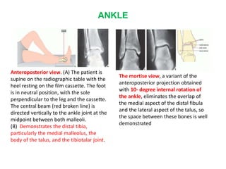 ANKLE
Anteroposterior view. (A) The patient is
supine on the radiographic table with the
heel resting on the film cassette. The foot
is in neutral position, with the sole
perpendicular to the leg and the cassette.
The central beam (red broken line) is
directed vertically to the ankle joint at the
midpoint between both malleoli.
(B) Demonstrates the distal tibia,
particularly the medial malleolus, the
body of the talus, and the tibiotalar joint.
The mortise view, a variant of the
anteroposterior projection obtained
with 10- degree internal rotation of
the ankle, eliminates the overlap of
the medial aspect of the distal fibula
and the lateral aspect of the talus, so
the space between these bones is well
demonstrated
 